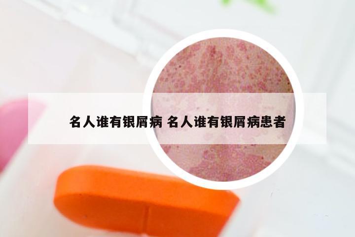 名人谁有银屑病 名人谁有银屑病患者