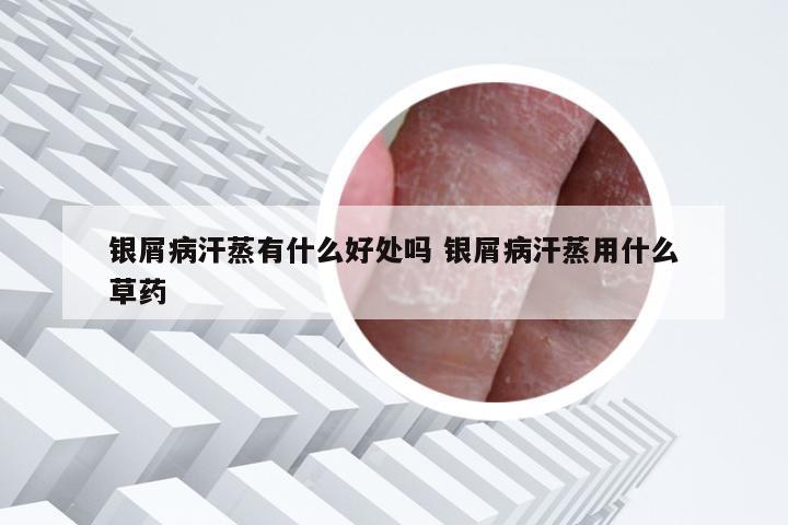 银屑病汗蒸有什么好处吗 银屑病汗蒸用什么草药