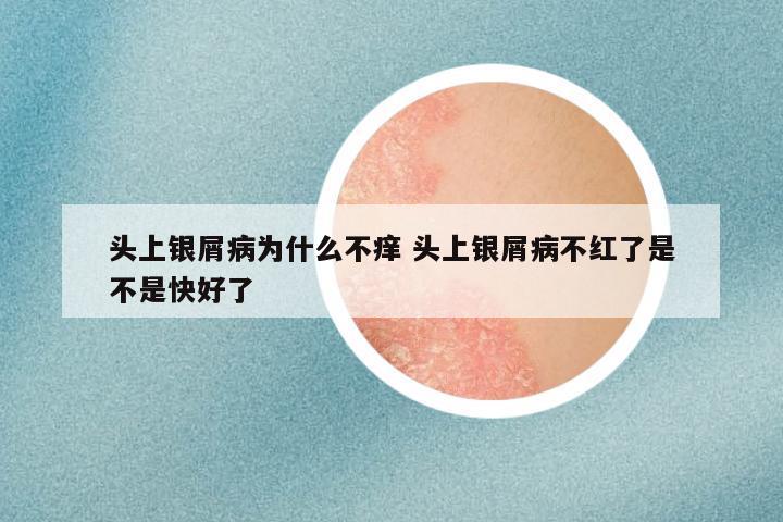 头上银屑病为什么不痒 头上银屑病不红了是不是快好了