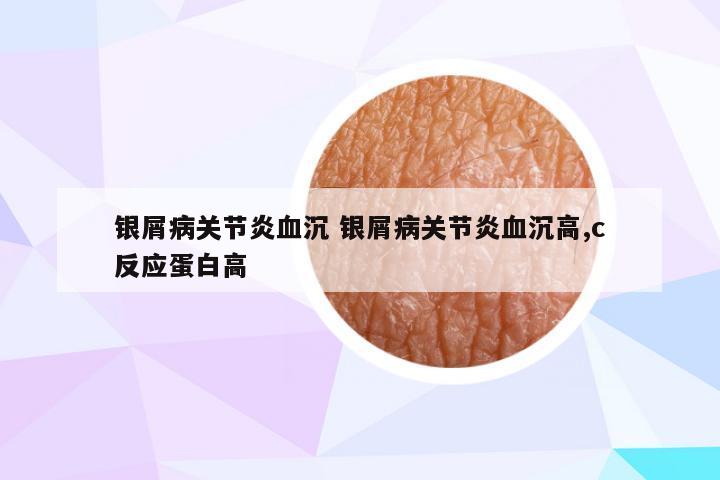 银屑病关节炎血沉 银屑病关节炎血沉高,c反应蛋白高