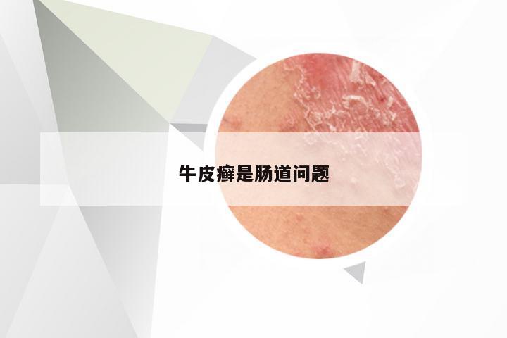 牛皮癣是肠道问题