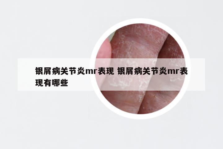 银屑病关节炎mr表现 银屑病关节炎mr表现有哪些
