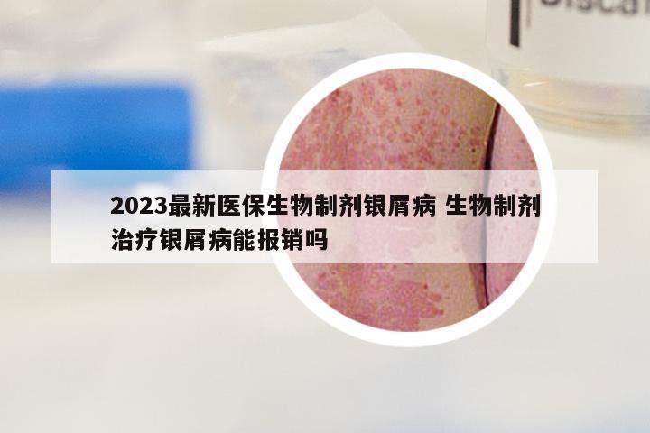 2023最新医保生物制剂银屑病 生物制剂治疗银屑病能报销吗