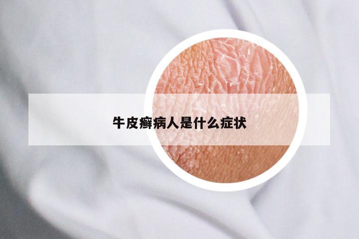 牛皮癣病人是什么症状