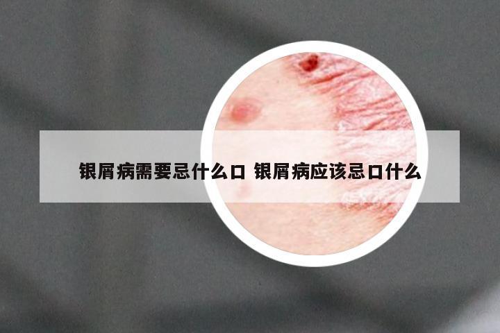 银屑病需要忌什么口 银屑病应该忌口什么