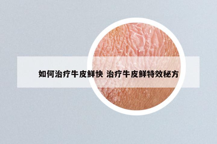 如何治疗牛皮鲜快 治疗牛皮鲜特效秘方