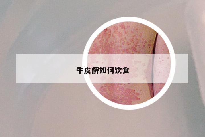 牛皮癣如何饮食