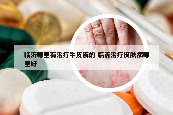 临沂哪里有治疗牛皮癣的 临沂治疗皮肤病哪里好