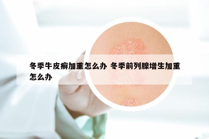 冬季牛皮癣加重怎么办 冬季前列腺增生加重怎么办