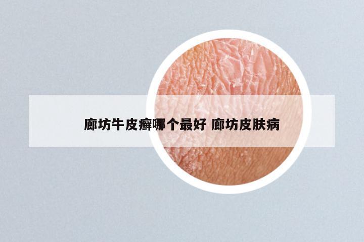 廊坊牛皮癣哪个最好 廊坊皮肤病