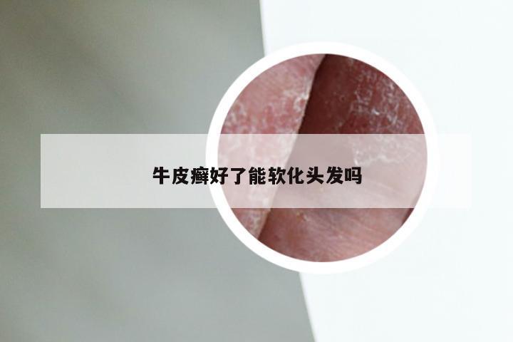 牛皮癣好了能软化头发吗