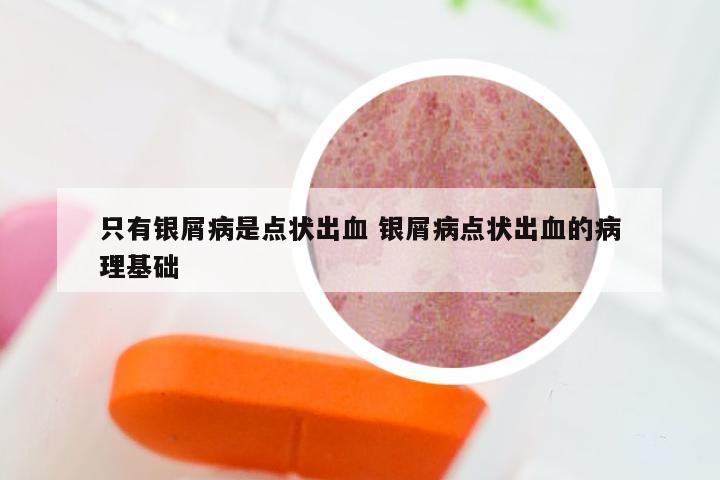 只有银屑病是点状出血 银屑病点状出血的病理基础