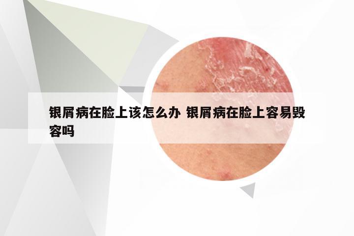 银屑病在脸上该怎么办 银屑病在脸上容易毁容吗