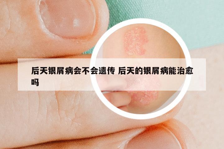 后天银屑病会不会遗传 后天的银屑病能治愈吗