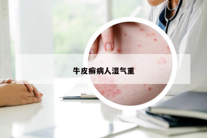 牛皮癣病人湿气重