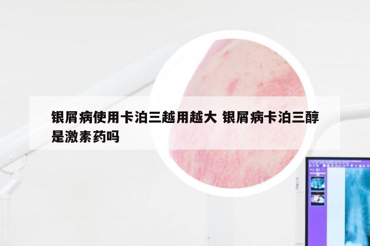 银屑病使用卡泊三越用越大 银屑病卡泊三醇是激素药吗