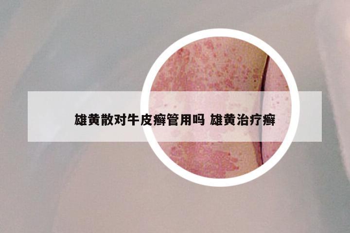 雄黄散对牛皮癣管用吗 雄黄治疗癣