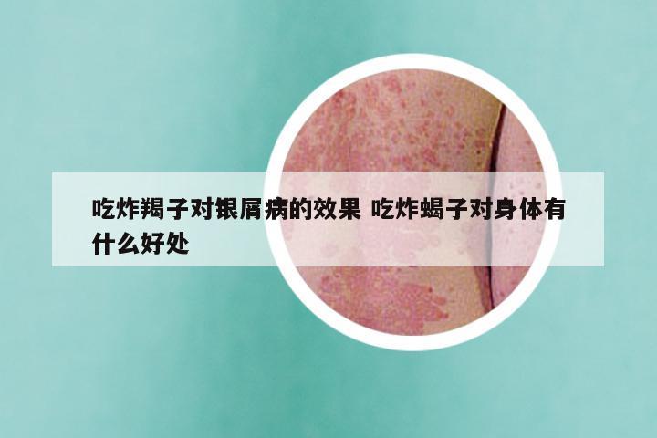 吃炸羯子对银屑病的效果 吃炸蝎子对身体有什么好处