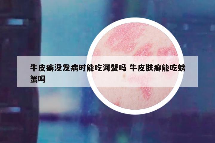 牛皮癣没发病时能吃河蟹吗 牛皮肤癣能吃螃蟹吗