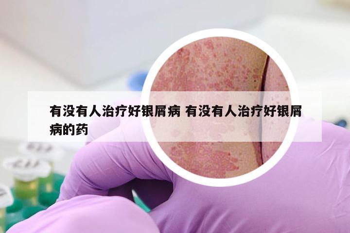 有没有人治疗好银屑病 有没有人治疗好银屑病的药