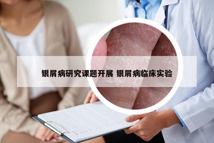 银屑病研究课题开展 银屑病临床实验