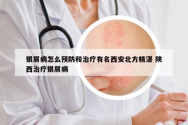银屑病怎么预防和治疗有名西安北方精湛 陕西治疗银屑病
