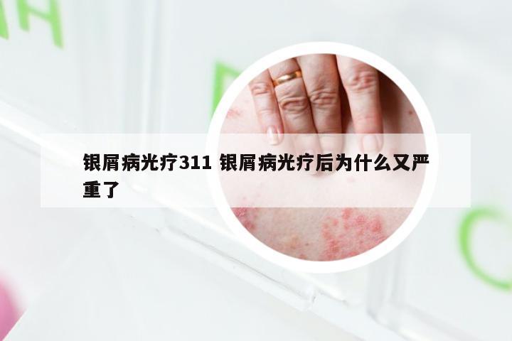 银屑病光疗311 银屑病光疗后为什么又严重了
