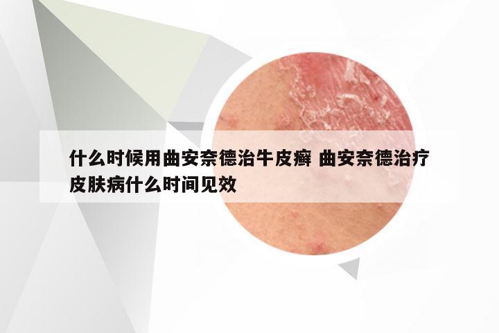 什么时候用曲安奈德治牛皮癣 曲安奈德治疗皮肤病什么时间见效