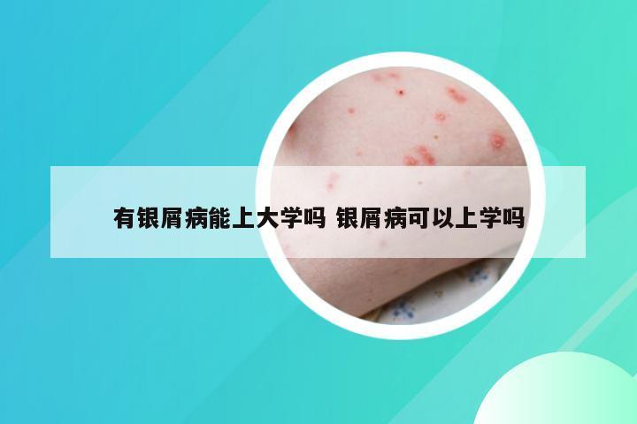 有银屑病能上大学吗 银屑病可以上学吗