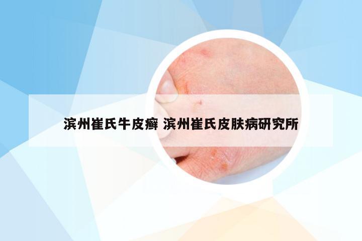 滨州崔氏牛皮癣 滨州崔氏皮肤病研究所