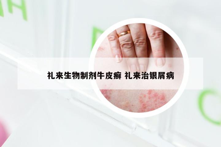 礼来生物制剂牛皮癣 礼来治银屑病