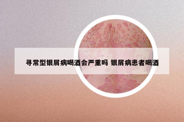 寻常型银屑病喝酒会严重吗 银屑病患者喝酒
