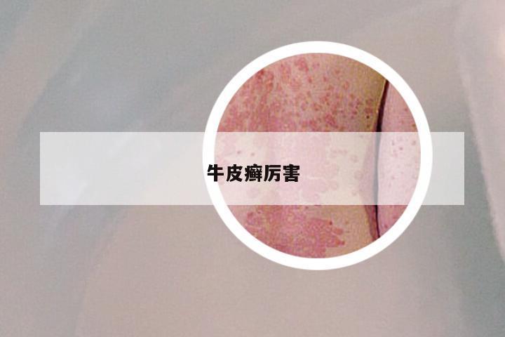 牛皮癣厉害