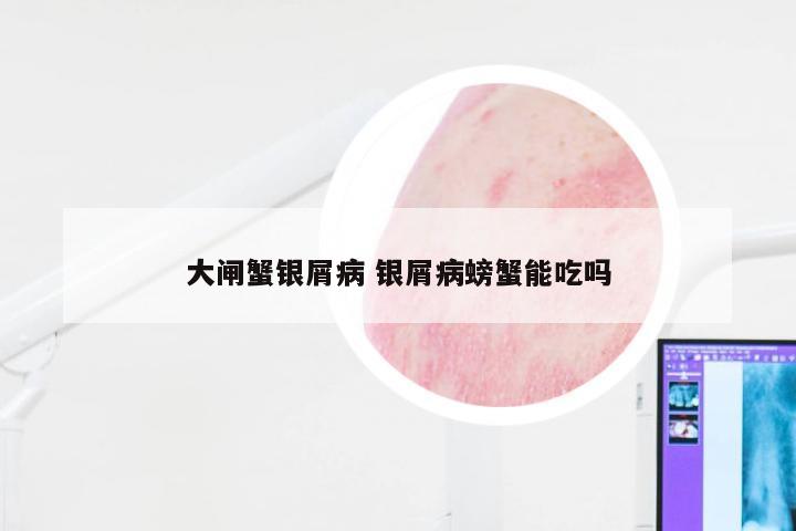 大闸蟹银屑病 银屑病螃蟹能吃吗