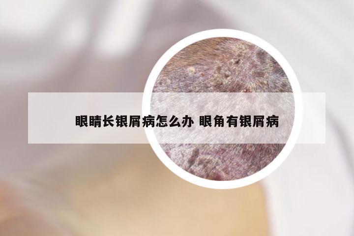 眼睛长银屑病怎么办 眼角有银屑病
