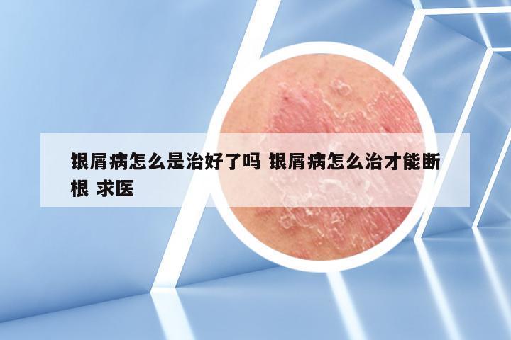 银屑病怎么是治好了吗 银屑病怎么治才能断根 求医