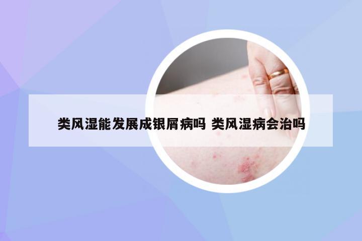 类风湿能发展成银屑病吗 类风湿病会治吗