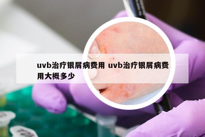uvb治疗银屑病费用 uvb治疗银屑病费用大概多少