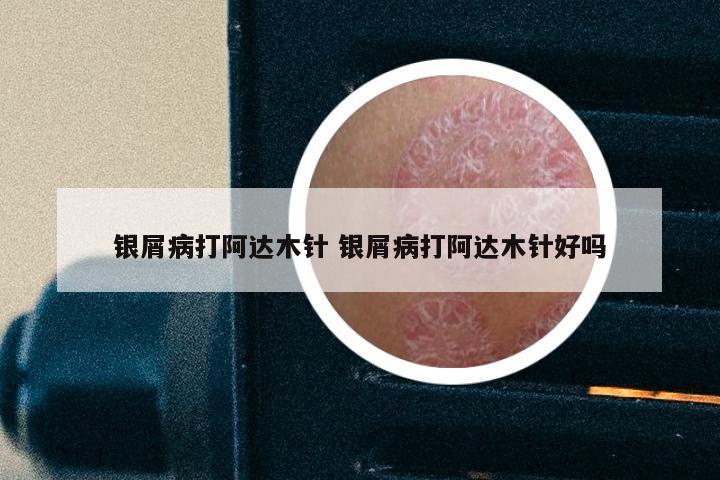银屑病打阿达木针 银屑病打阿达木针好吗