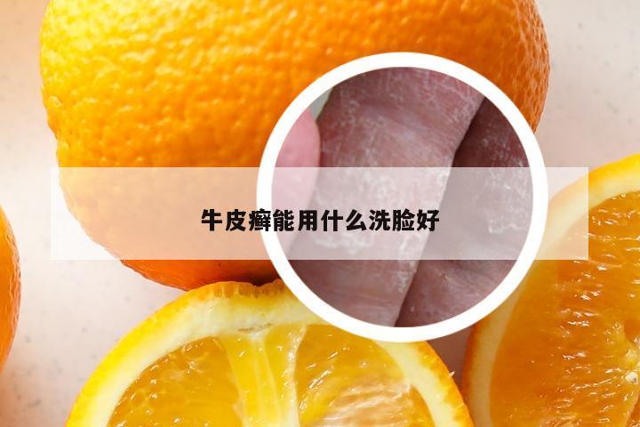 牛皮癣能用什么洗脸好