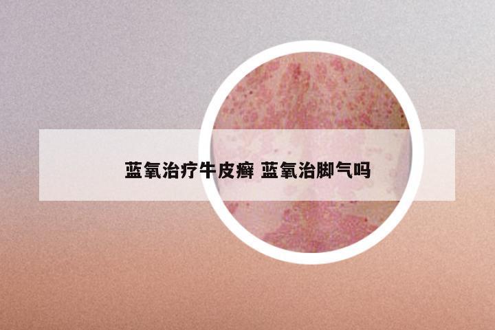 蓝氧治疗牛皮癣 蓝氧治脚气吗