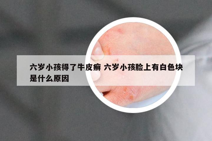 六岁小孩得了牛皮癣 六岁小孩脸上有白色块是什么原因