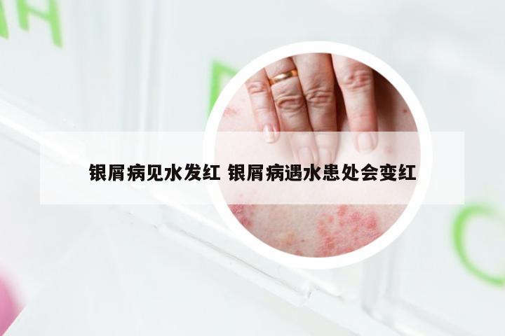 银屑病见水发红 银屑病遇水患处会变红