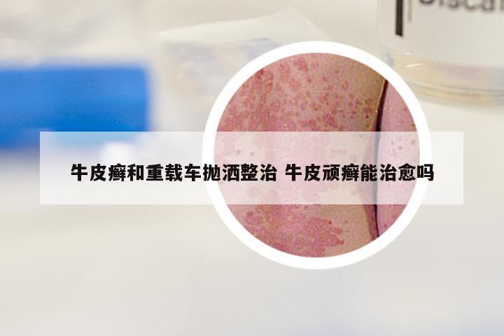 牛皮癣和重载车抛洒整治 牛皮顽癣能治愈吗