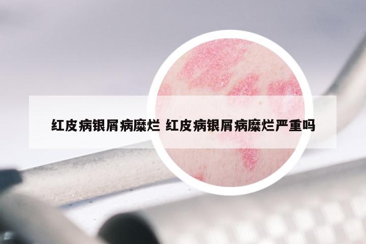 红皮病银屑病糜烂 红皮病银屑病糜烂严重吗