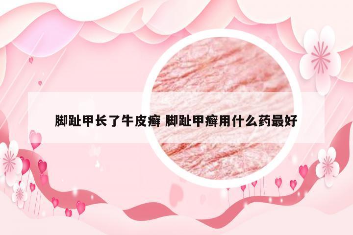 脚趾甲长了牛皮癣 脚趾甲癣用什么药最好