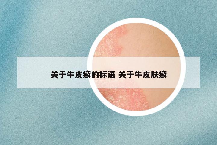 关于牛皮癣的标语 关于牛皮肤癣