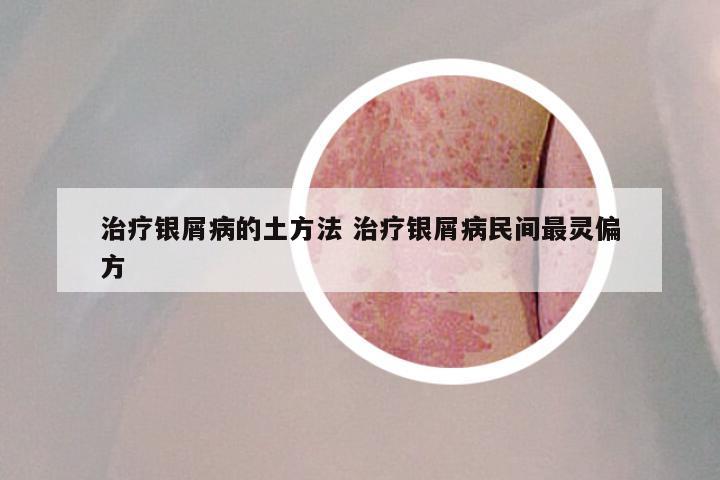 治疗银屑病的土方法 治疗银屑病民间最灵偏方