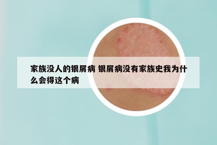 家族没人的银屑病 银屑病没有家族史我为什么会得这个病