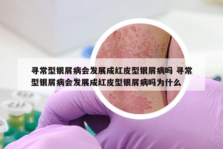 寻常型银屑病会发展成红皮型银屑病吗 寻常型银屑病会发展成红皮型银屑病吗为什么
